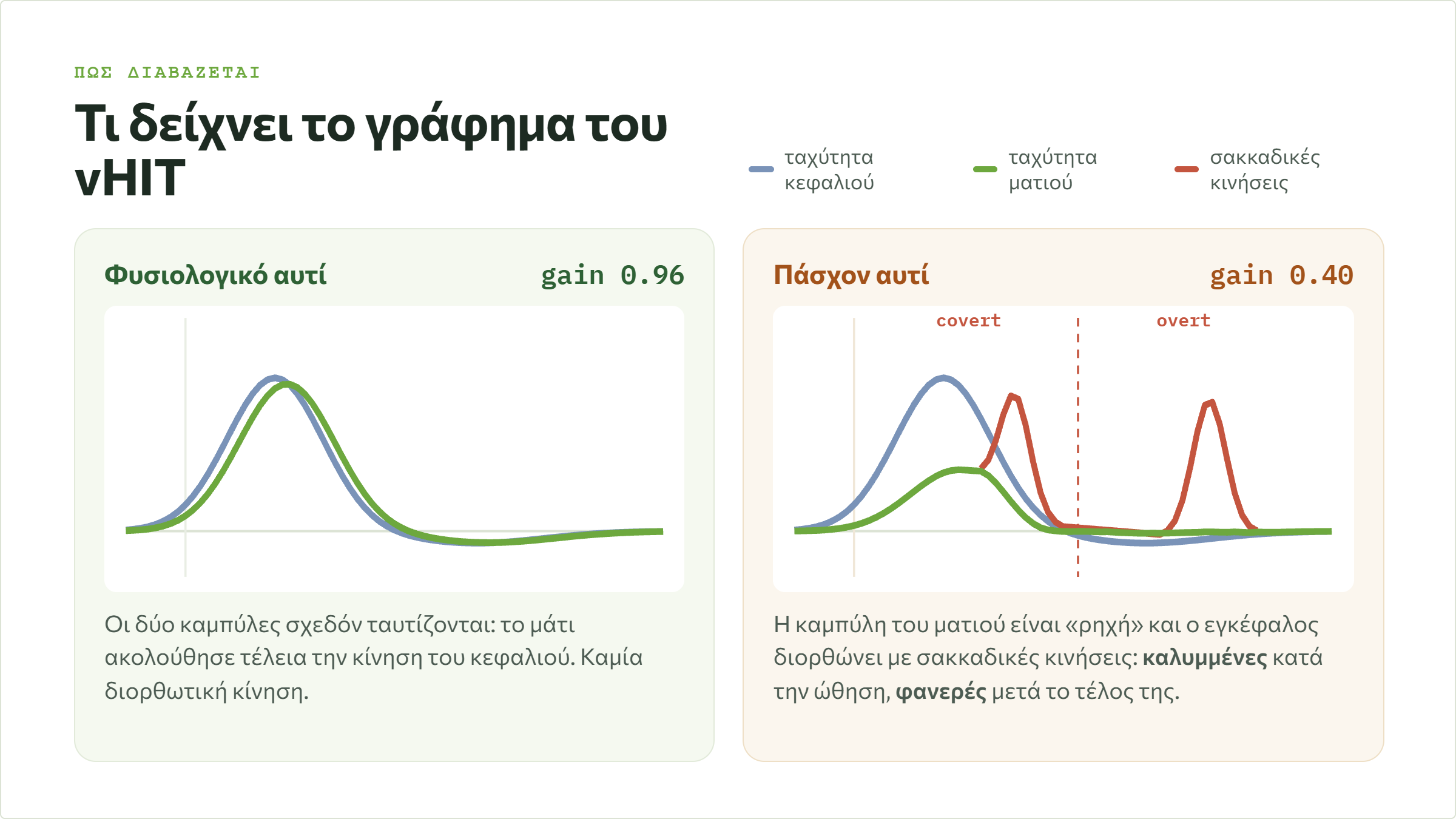 Σύγκριση γραφημάτων vHIT: φυσιολογικό αυτί με κέρδος 0.96 και πάσχον αυτί με κέρδος 0.40 και διορθωτικές σακκαδικές κινήσεις, καλυμμένες και φανερές